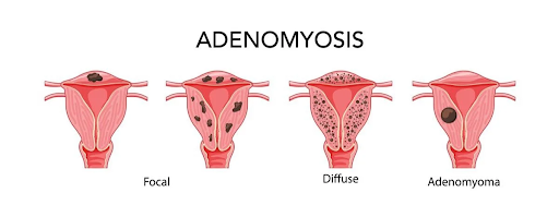 Stages of Adenomyosis