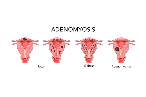 Stages of Adenomyosis