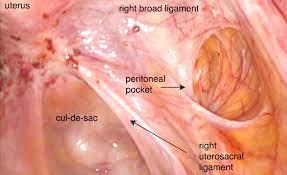 Endometriosis involving the base of the uterus, the pelvis (culdesac) and the peritoneum of the right uterine sidewall