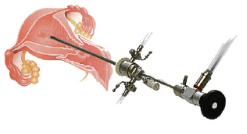 A Hysteroscope is used to look inside the uterine cavity for a biopsy