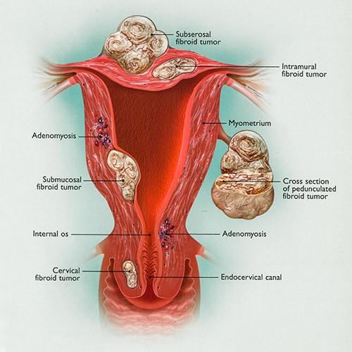 Diagram of abnormal bleeding in the uterus