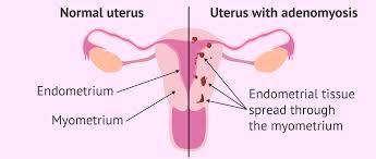 Normal Uterus on the left, Adenomyosis on the right – the endometrial glands grow into the myometrium, or muscle of the uterus. 