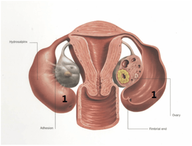 Diagram showing some of a woman's reproductive parts with adhesions