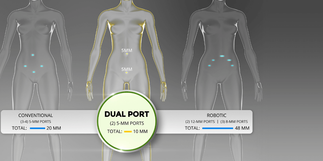 DualPortGYN port comparison