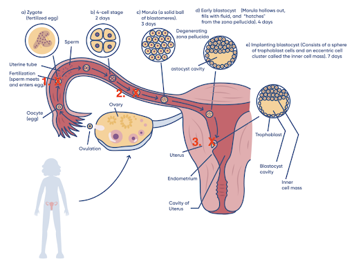 Diagram that shows a woman's reproductive system with complications
