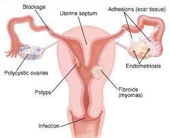 Illustration of a female reproductive system with endometriosis
