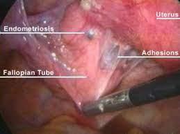 Adhesions between endometriosis, the fallopian tube, and the uterus