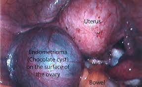 Large endometrioma in the left ovary