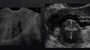 Hysterosonogram showing a fibroid in the uterine cavity, with is filled with water.