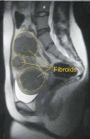 3 fibroids shown in a scan