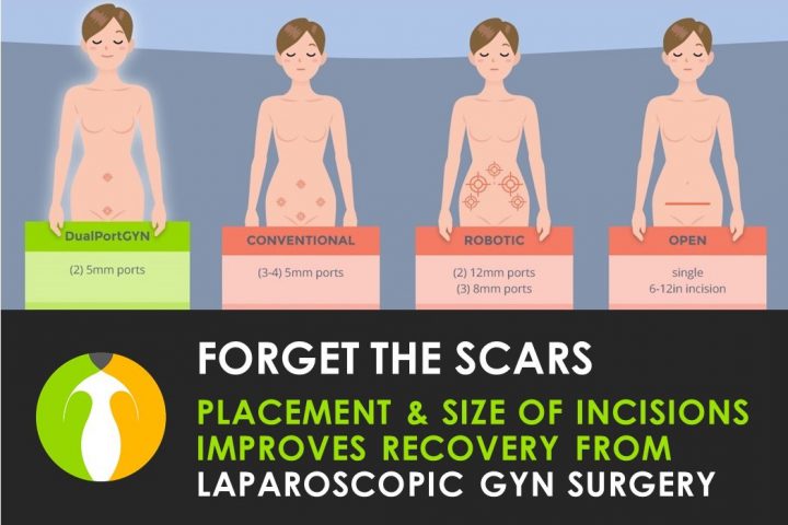 Placement and size of incisions improves recovery from laparoscopic GYN surgery