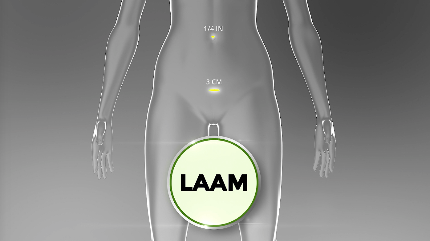 LAAM port illustration