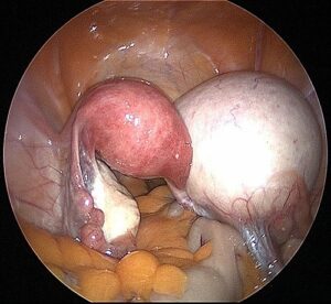 Large Right Dermoid Cyst. In this picture, the Dermoid Cyst is larger than the uterus. 