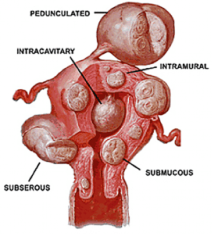 Fibroid types