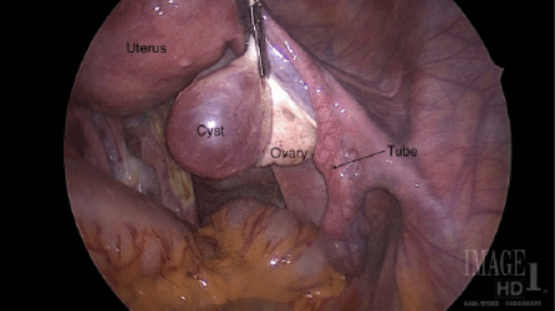 Labeled image of an ovarian cystectomy