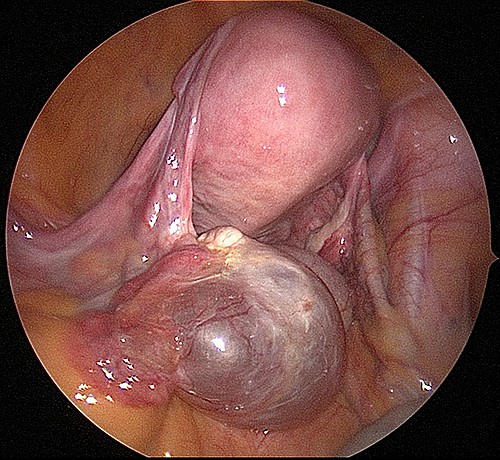 A typical serous cyst, in this case, to the left ovary. These cysts contain clear serous fluid that is thin and water. 