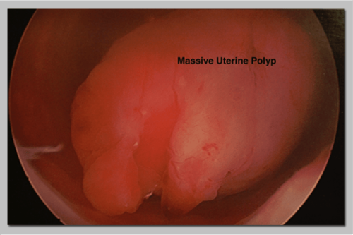 Labeled image showing a massive uterine polyp