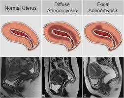 Image of uterus