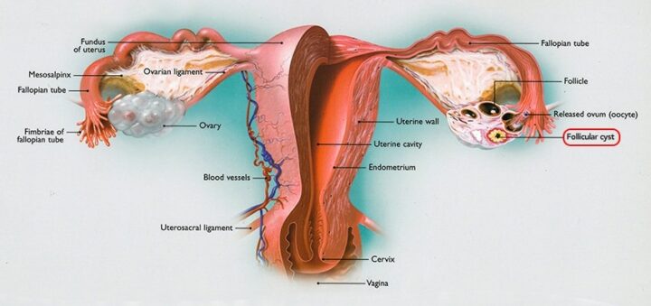 Diagram of a female reproductive system with a circled follicular cyst