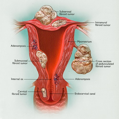 Diagram of a woman's reproductive system with fibroids