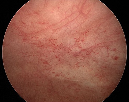 Close up image showing petechiae, or bleeding spots