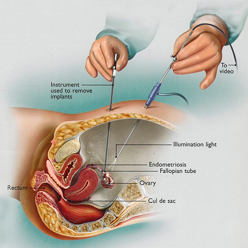 Illustrated diagram showing a laparoscopic surgery