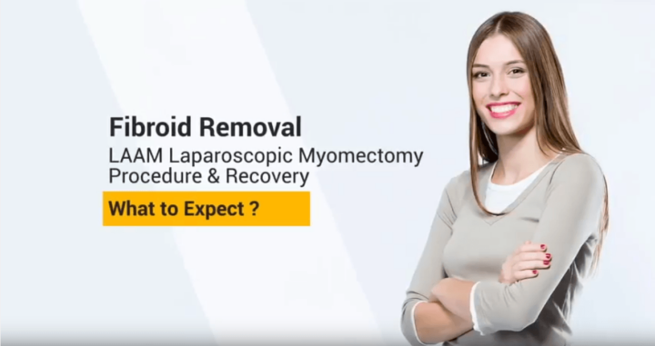 Fibroid removal, what to expect