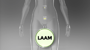 LAAM: Safer fibroid removal for fertility