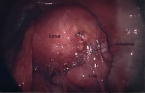 Resection-Pelvic-Adhesions