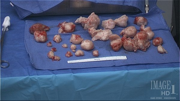 Infertiity fibroids removed