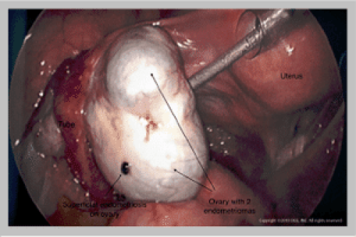 Ovary Endometrioma