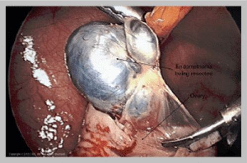Ovary Resected