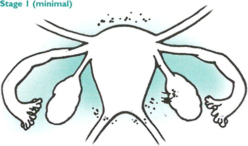 stages endometriosis Stage 1