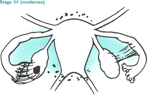 stages endometriosis Stage 3